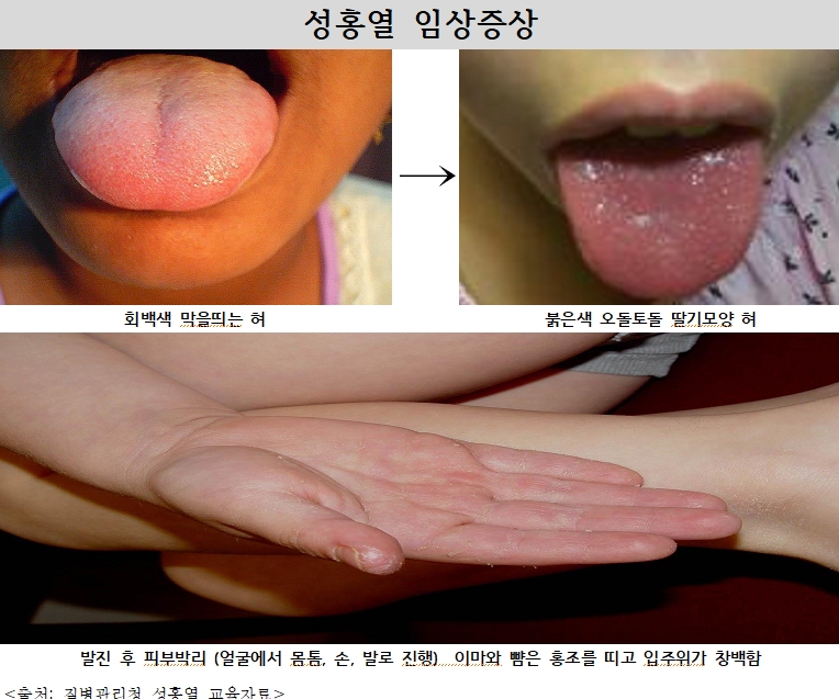 옹진군, ‘성홍열 집단발생 주의 홍보’